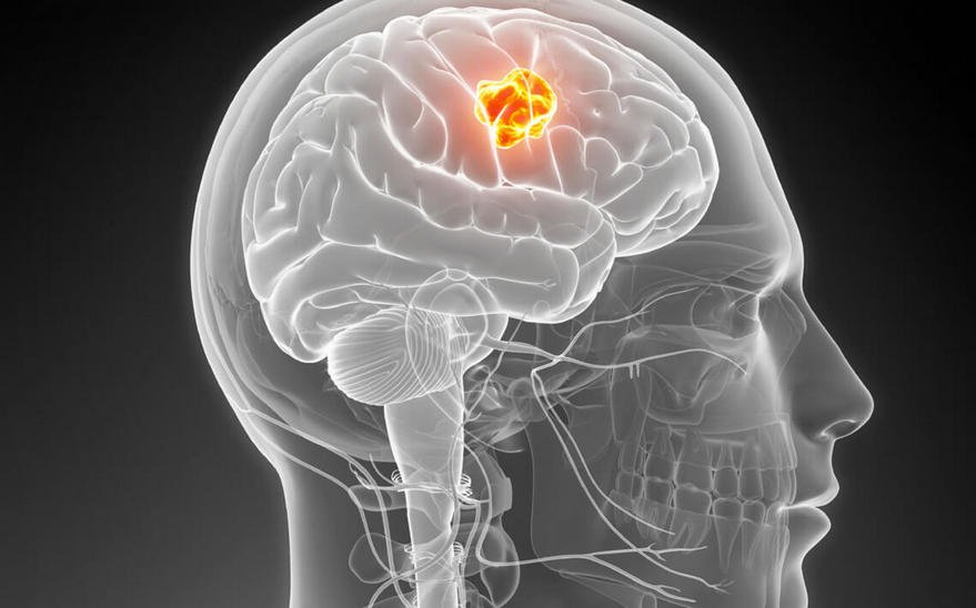 Нижегородские ученые создали новую систему диагностики опухоли мозга