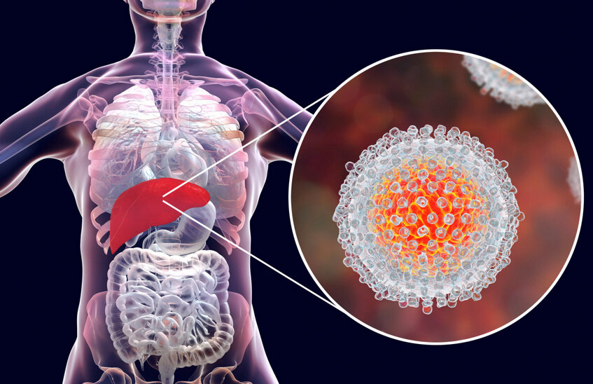 20 случаев вирусного гепатита С выявлено в Сарове за год